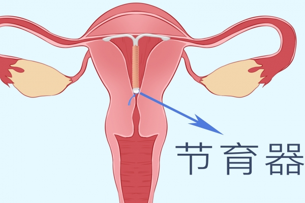 戴节育环副作用