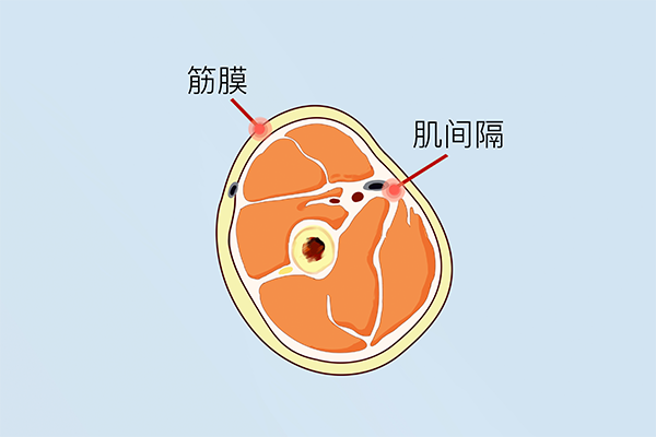 筋膜炎的症状及治疗