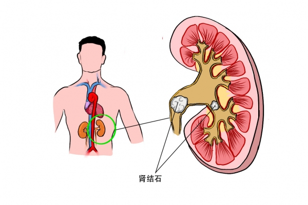 肾结石严重吗