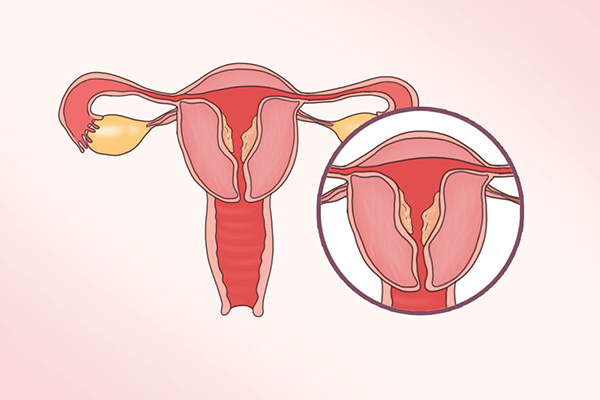 子宫内膜厚需要刮宫吗