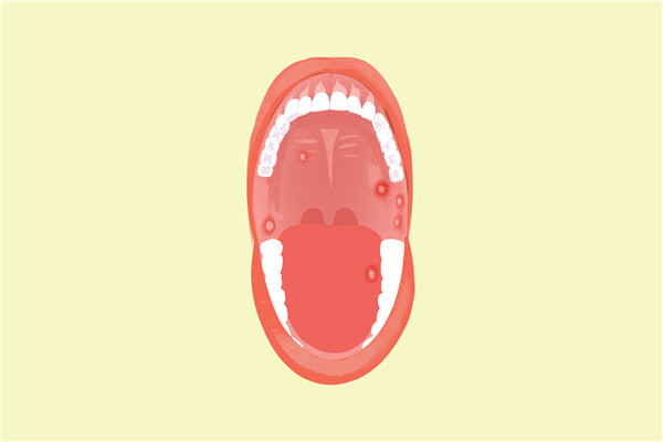 口腔溃疡是缺维生素吗