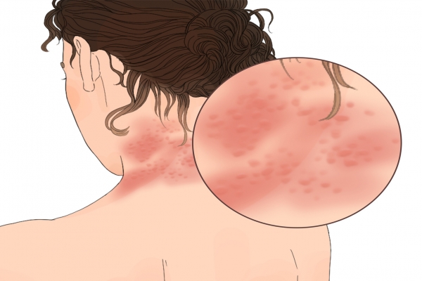 过敏体质怎么改善