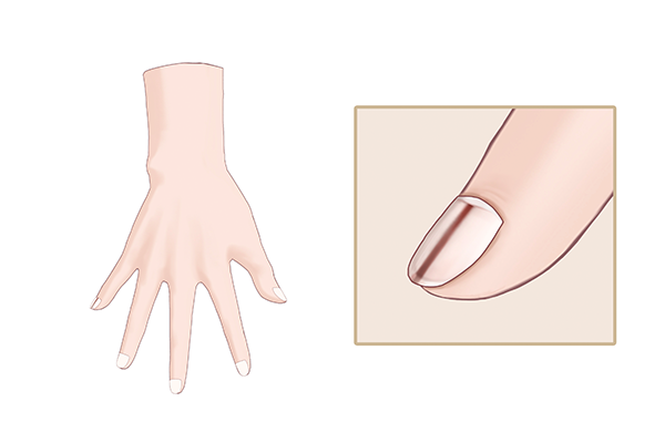 指甲有竖纹是什么原因