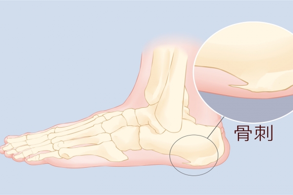脚后跟痛是什么原因