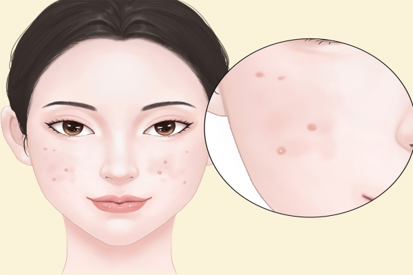 脸上长痘怎么调理